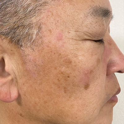 Dr.PUR BEAUTEご利用前